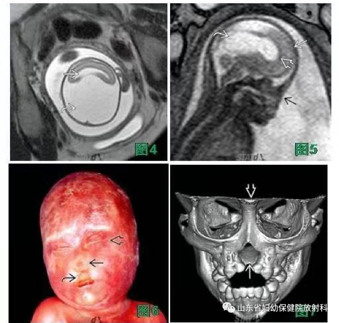 中央变异型前脑无裂畸形鉴别诊断_医学界-助力医生临床决策和职业成长