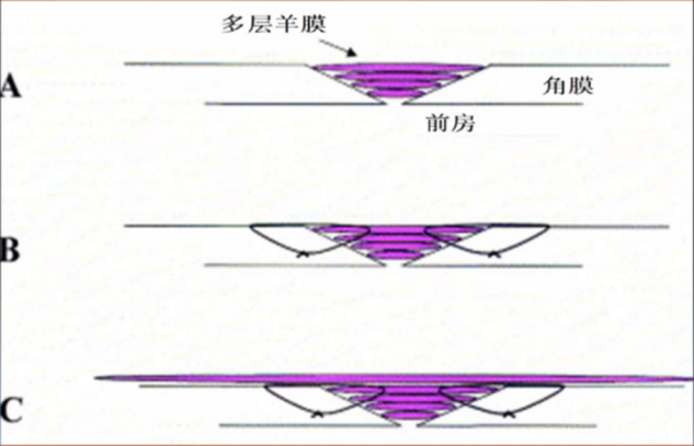 手术膜怎么用胎盘内的一层膜，竟在眼科手术中派上大用场！_https://www.jmylbn.com_新闻资讯_第10张