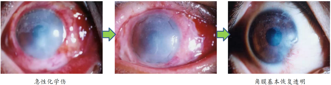 手术膜怎么用胎盘内的一层膜，竟在眼科手术中派上大用场！_https://www.jmylbn.com_新闻资讯_第4张