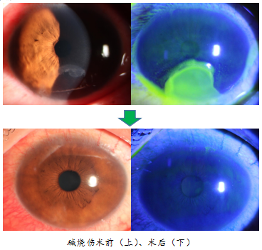 手术膜怎么用胎盘内的一层膜，竟在眼科手术中派上大用场！_https://www.jmylbn.com_新闻资讯_第5张