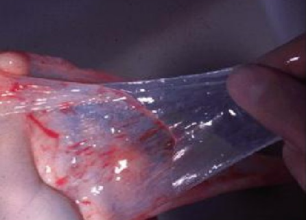 手术膜怎么用胎盘内的一层膜，竟在眼科手术中派上大用场！_https://www.jmylbn.com_新闻资讯_第7张