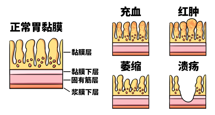 治疗脾胃疾病，先修复胃黏膜，这是治愈的关键！