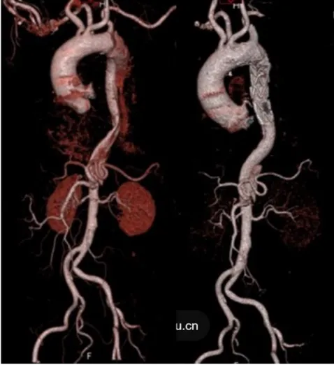 联影有哪些CT我院放射科再添“硬核“利器—联影60排120层螺旋CT机_https://www.jmylbn.com_新闻资讯_第30张
