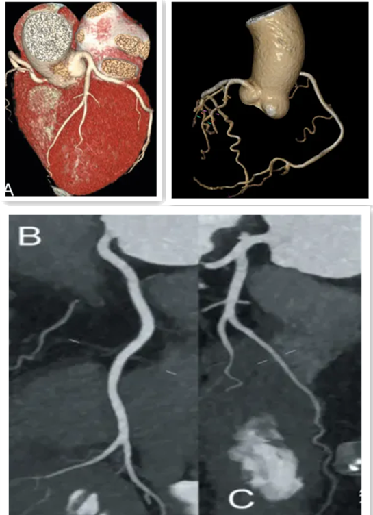 联影有哪些CT我院放射科再添“硬核“利器—联影60排120层螺旋CT机_https://www.jmylbn.com_新闻资讯_第28张