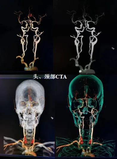 联影有哪些CT我院放射科再添“硬核“利器—联影60排120层螺旋CT机_https://www.jmylbn.com_新闻资讯_第24张