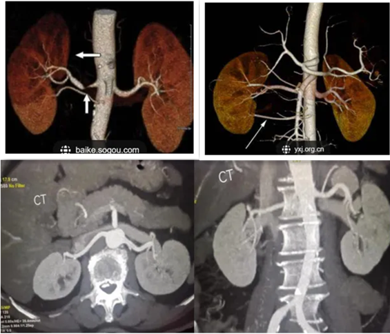 联影有哪些CT我院放射科再添“硬核“利器—联影60排120层螺旋CT机_https://www.jmylbn.com_新闻资讯_第40张