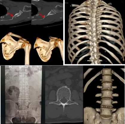 联影有哪些CT我院放射科再添“硬核“利器—联影60排120层螺旋CT机_https://www.jmylbn.com_新闻资讯_第22张