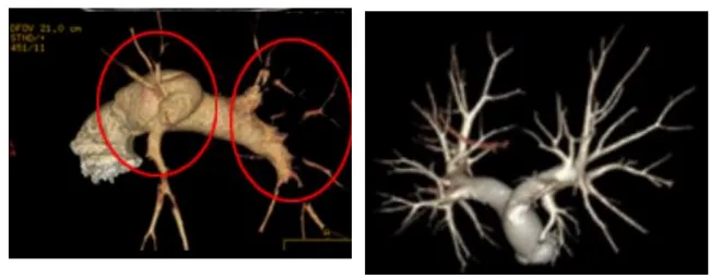 联影有哪些CT我院放射科再添“硬核“利器—联影60排120层螺旋CT机_https://www.jmylbn.com_新闻资讯_第32张