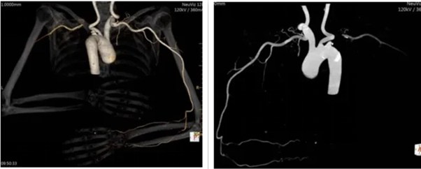 联影有哪些CT我院放射科再添“硬核“利器—联影60排120层螺旋CT机_https://www.jmylbn.com_新闻资讯_第34张