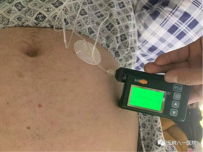 医疗泵什么【医疗动态】“胰岛素泵”平稳降糖-----拓展糖尿病治疗新方式_https://www.jmylbn.com_新闻资讯_第1张