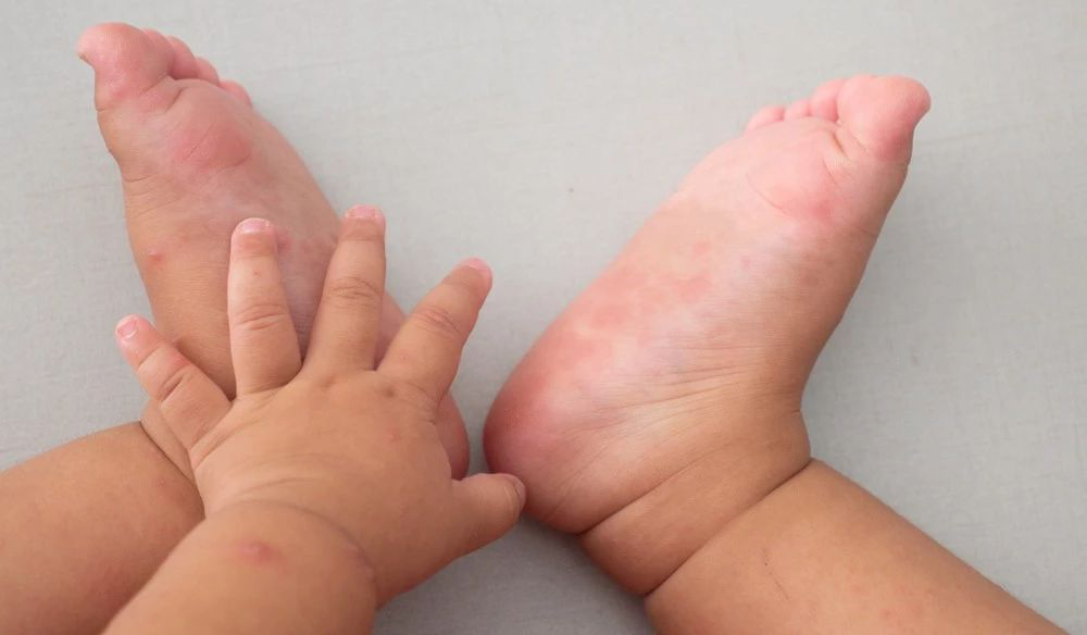 手足口病進入第二個高發期，孩子有這6種症狀，需馬上就醫！ 親子 第8張