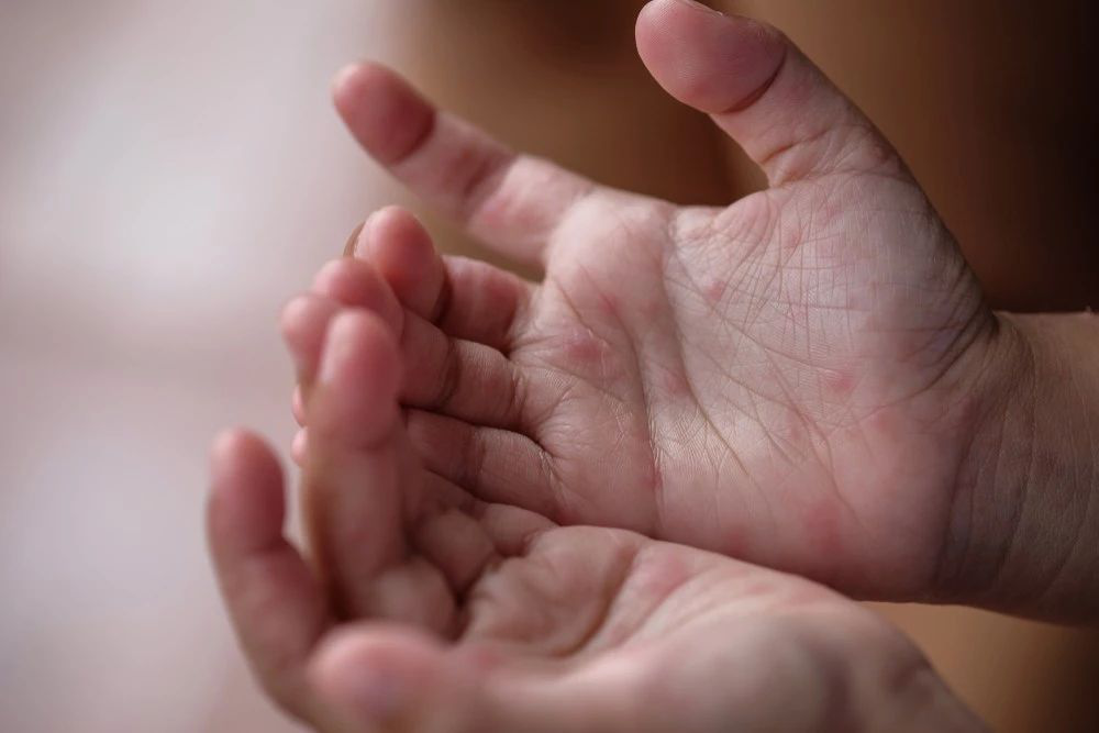 手足口病進入第二個高發期，孩子有這6種症狀，需馬上就醫！ 親子 第4張