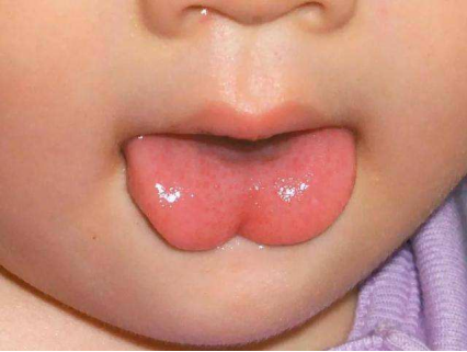 快看看孩子的舌头,有这种情况千万留意! 