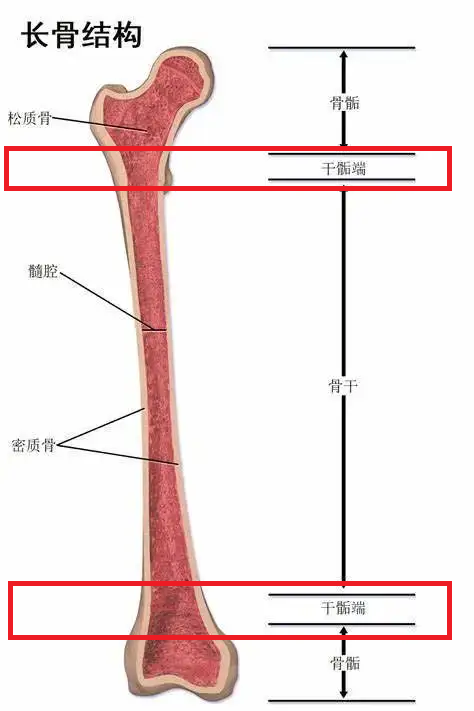 时期的恶性骨肿瘤,也就是很多人俗称的"骨癌",常发生在四肢长骨干骺端