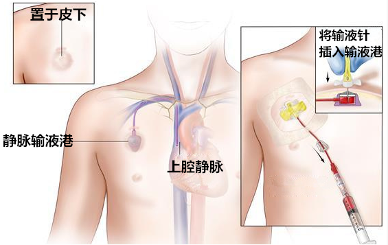 picc包含哪些套件【科普】一文读懂PICC_https://www.jmylbn.com_新闻资讯_第7张