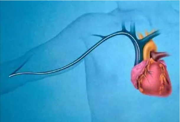 picc包含哪些套件【科普】一文读懂PICC_https://www.jmylbn.com_新闻资讯_第4张