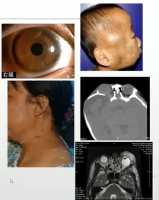 虹膜错构瘤神经纤维瘤图片