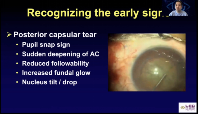 晶状体核碎块掉入玻璃体腔如何处理