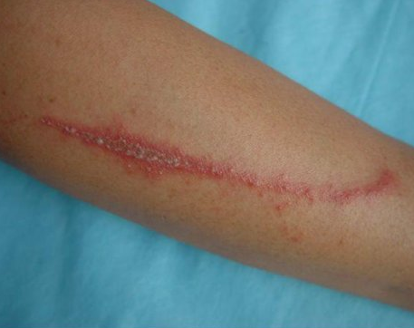 那些“千奇百怪”的虫咬皮炎