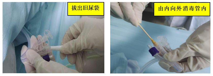 为什么要引流尿袋【科普】留置尿管患者如何进行居家护理？_https://www.jmylbn.com_新闻资讯_第8张