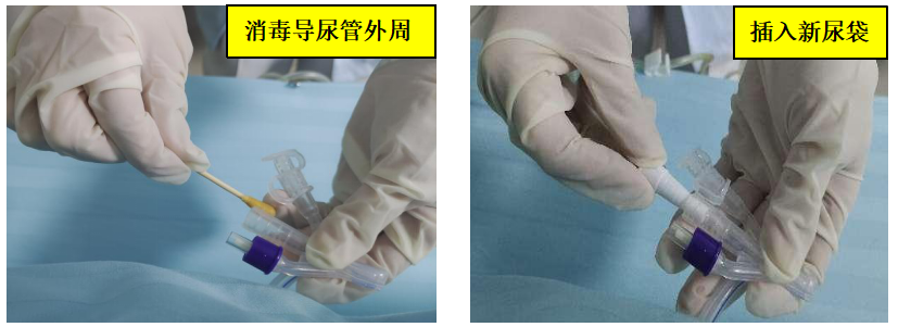 为什么要引流尿袋【科普】留置尿管患者如何进行居家护理？_https://www.jmylbn.com_新闻资讯_第9张