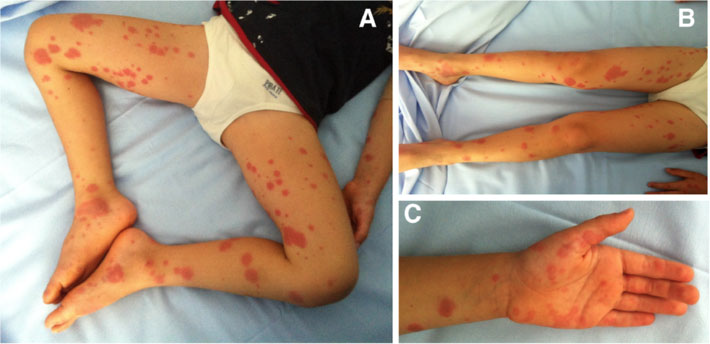 分别为发热第4天,第5天,第7天的下肢靶形红斑[6]儿童多形红斑还可能与