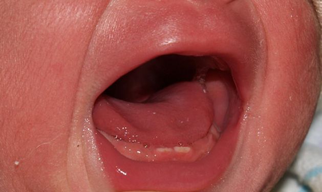 新生宝宝口腔图谱（让你害怕和担心的正常现象）