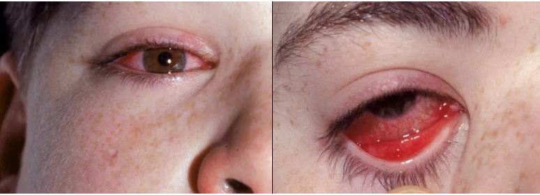 症状粗略的考虑是哪个疾病,比如如果孩子同时有结膜炎,那考虑腺病毒