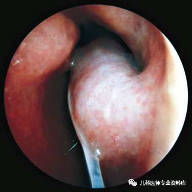 发现孩子鼻粘膜是呈苍白水肿(灰白色或者灰蓝色),并且伴有鼻甲水肿
