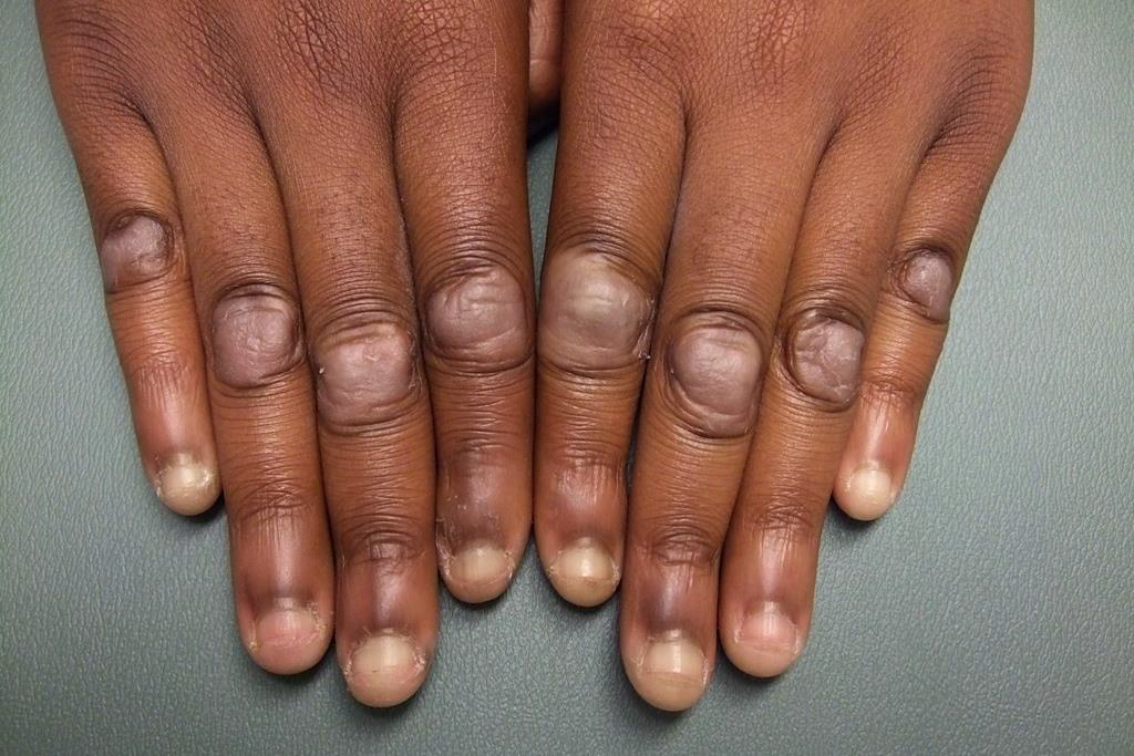 手指上的结节是孩子自己咬的还是有严重问题