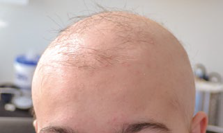 斑秃的受累面积可能逐渐扩大,出现全部头发脱落,此时称为全秃.