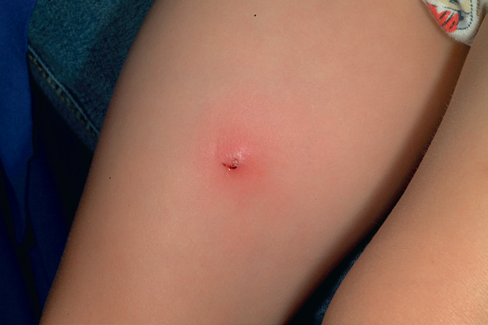 孩子出现肛周脓肿怎么办?保守好还是手术好?能接种疫苗吗?