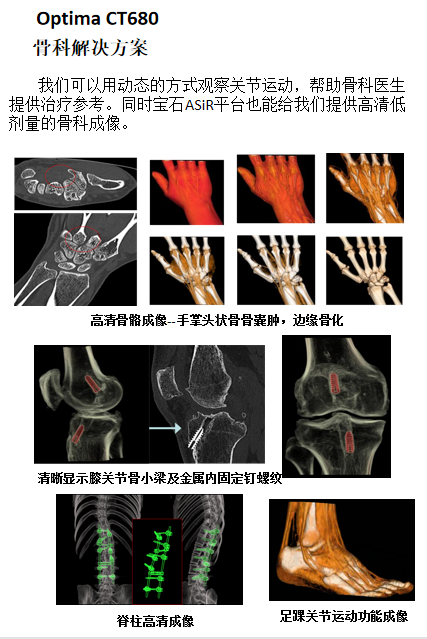 Optima什么医疗【医疗动态】我院又添新“利器”！引进美国GE高端128层CT—Optima CT680_https://www.jmylbn.com_新闻资讯_第5张