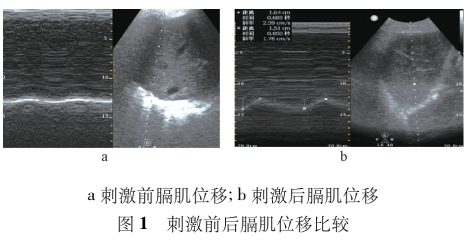 为什么会出现呼吸机依赖临床案例 ｜ 呼吸神经肌肉刺激仪在重症肌无力致呼吸机依赖患者脱机中的应用_https://www.jmylbn.com_新闻资讯_第3张