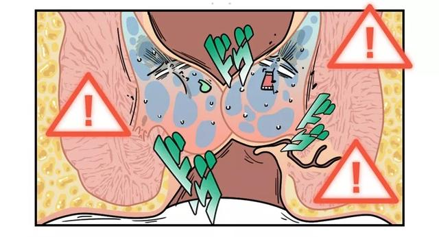 痔疮套扎吻合器怎么用无痛微创套扎治疗，让“有痔之士”轻松除痔_https://www.jmylbn.com_新闻资讯_第3张