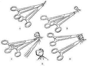 痔疮套扎吻合器怎么用无痛微创套扎治疗，让“有痔之士”轻松除痔_https://www.jmylbn.com_新闻资讯_第6张