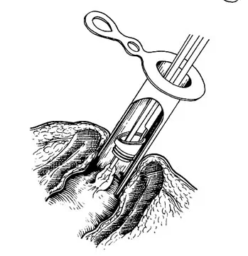 痔疮套扎吻合器怎么用无痛微创套扎治疗，让“有痔之士”轻松除痔_https://www.jmylbn.com_新闻资讯_第7张