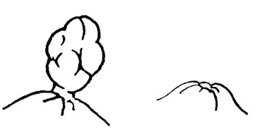 痔疮套扎吻合器怎么用无痛微创套扎治疗，让“有痔之士”轻松除痔_https://www.jmylbn.com_新闻资讯_第9张