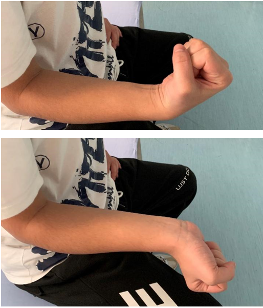 肘关节康复器怎么用专栏丨肘关节的术后康复_https://www.jmylbn.com_新闻资讯_第5张