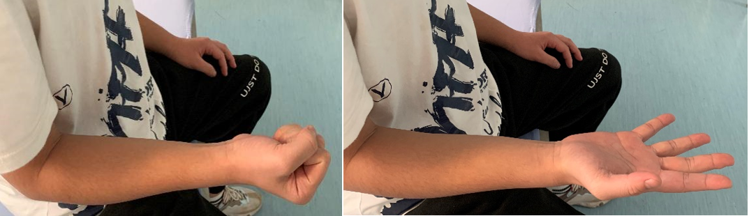 肘关节康复器怎么用专栏丨肘关节的术后康复_https://www.jmylbn.com_新闻资讯_第4张