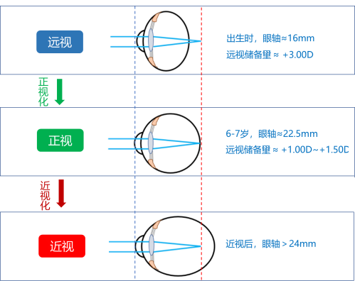 什么是屈光筛查仪小熊科普 ｜ 视力、屈光、眼轴、远视储备都是什么，听小熊君来解读_https://www.jmylbn.com_新闻资讯_第9张