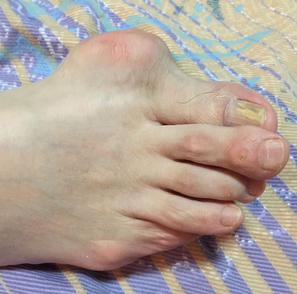 终于严重到第一跖趾关节(大脚趾)痛风石巨大,再也买不到可以穿的鞋子!