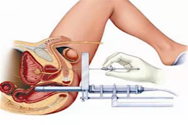 医疗技术前列腺癌诊断金标准超声引导下前列腺穿刺活检