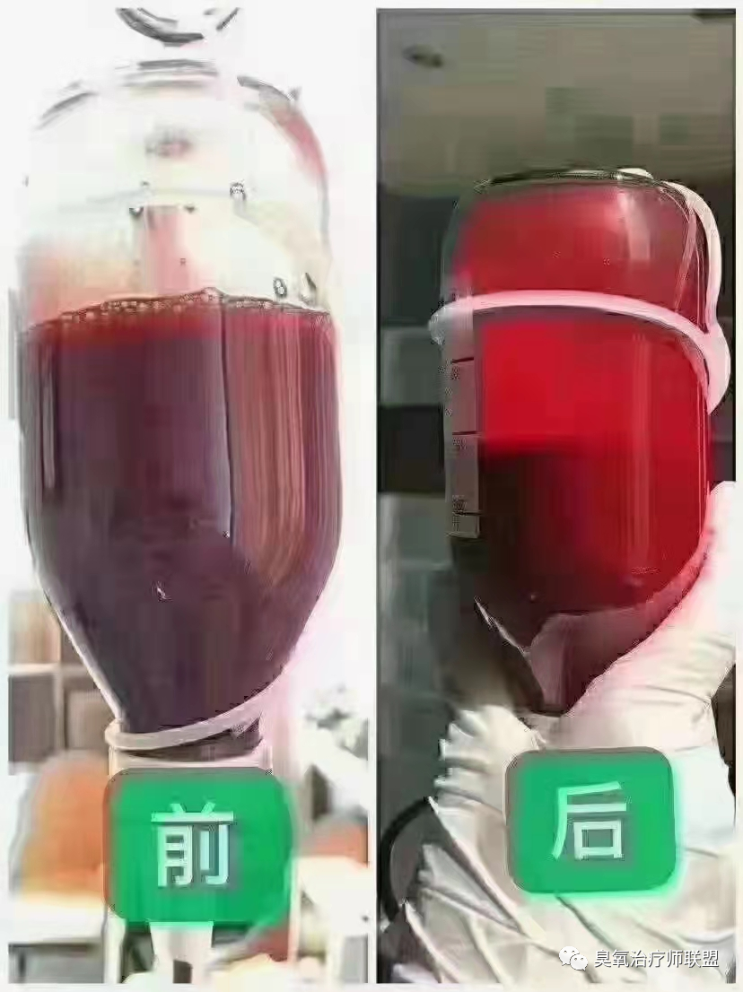高压臭氧治疗什么高剂量高压臭氧自血疗法（HOT）“净化血液提高免疫”_https://www.jmylbn.com_新闻资讯_第8张