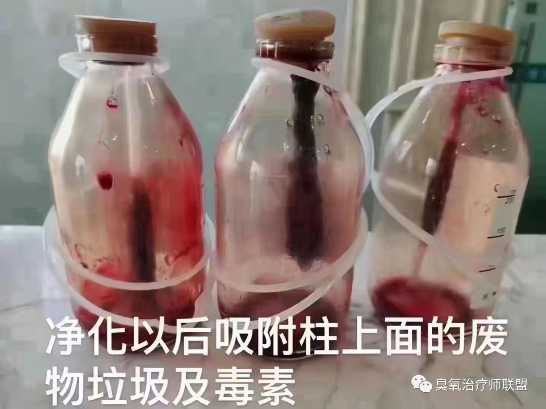 高压臭氧治疗什么高剂量高压臭氧自血疗法（HOT）“净化血液提高免疫”_https://www.jmylbn.com_新闻资讯_第10张