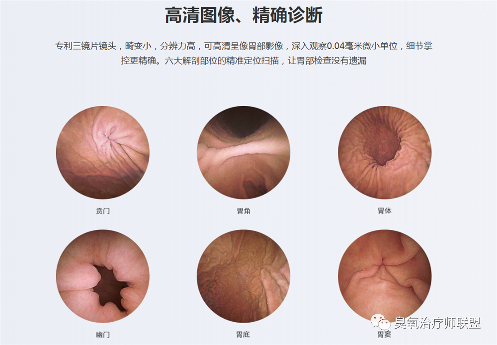 胃镜有哪些型号胃镜、肠镜、胶囊内镜—6种消化内镜介绍_https://www.jmylbn.com_新闻资讯_第5张