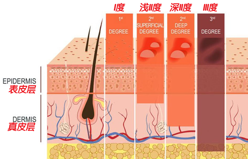 手被烫怎么办