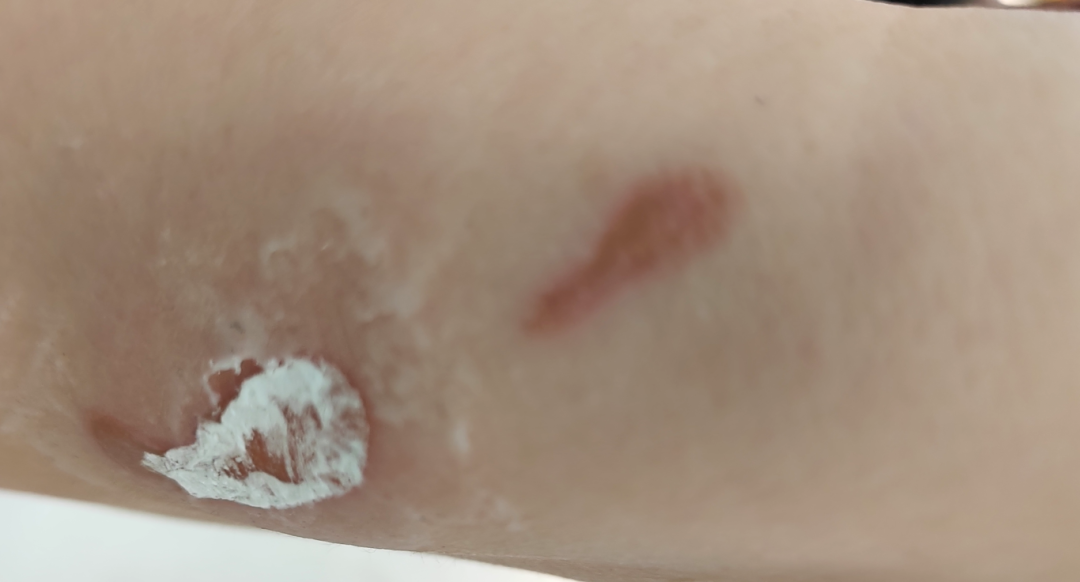 手被烫怎么办