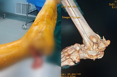 放射科怎么打印医院放射科医师登国家级平台：揭秘3D打印修复粉碎性骨折的“破局之道”_https://www.jmylbn.com_新闻资讯_第6张