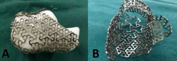 放射科怎么打印医院放射科医师登国家级平台：揭秘3D打印修复粉碎性骨折的“破局之道”_https://www.jmylbn.com_新闻资讯_第7张